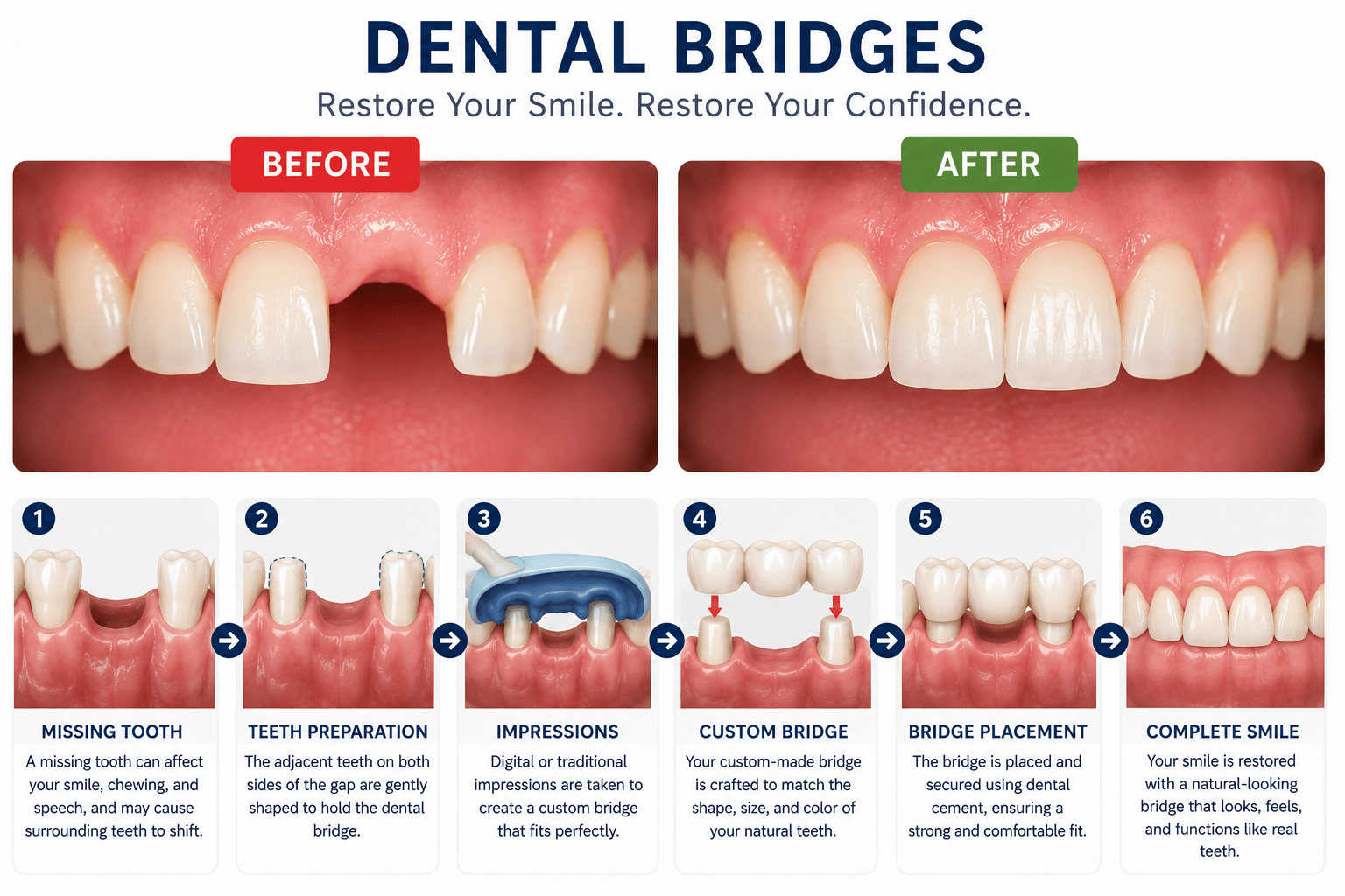 Dental bridges before and after comparison and step-by-step bridge placement procedure