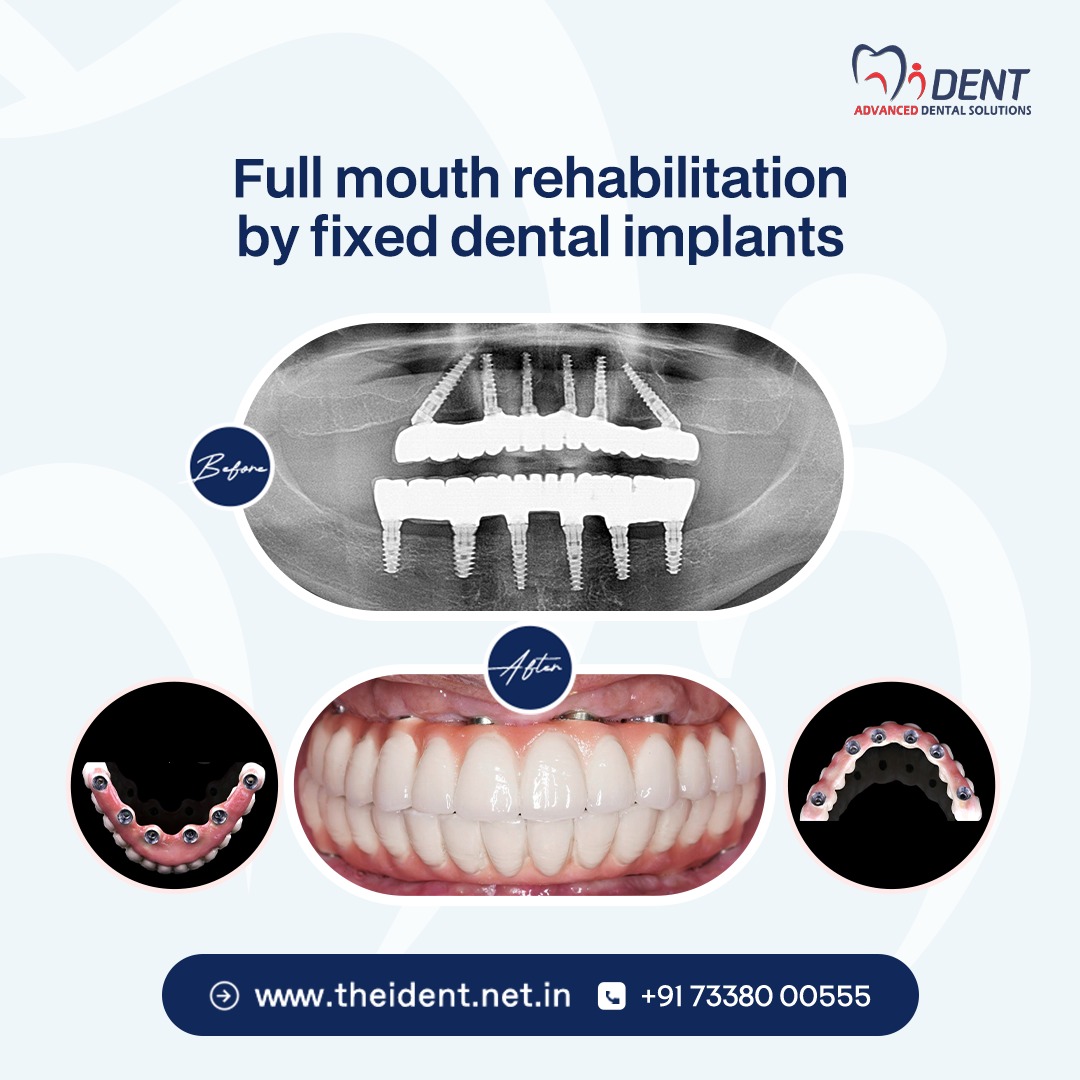 Full mouth rehabilitation by fixed dental implants at iDent