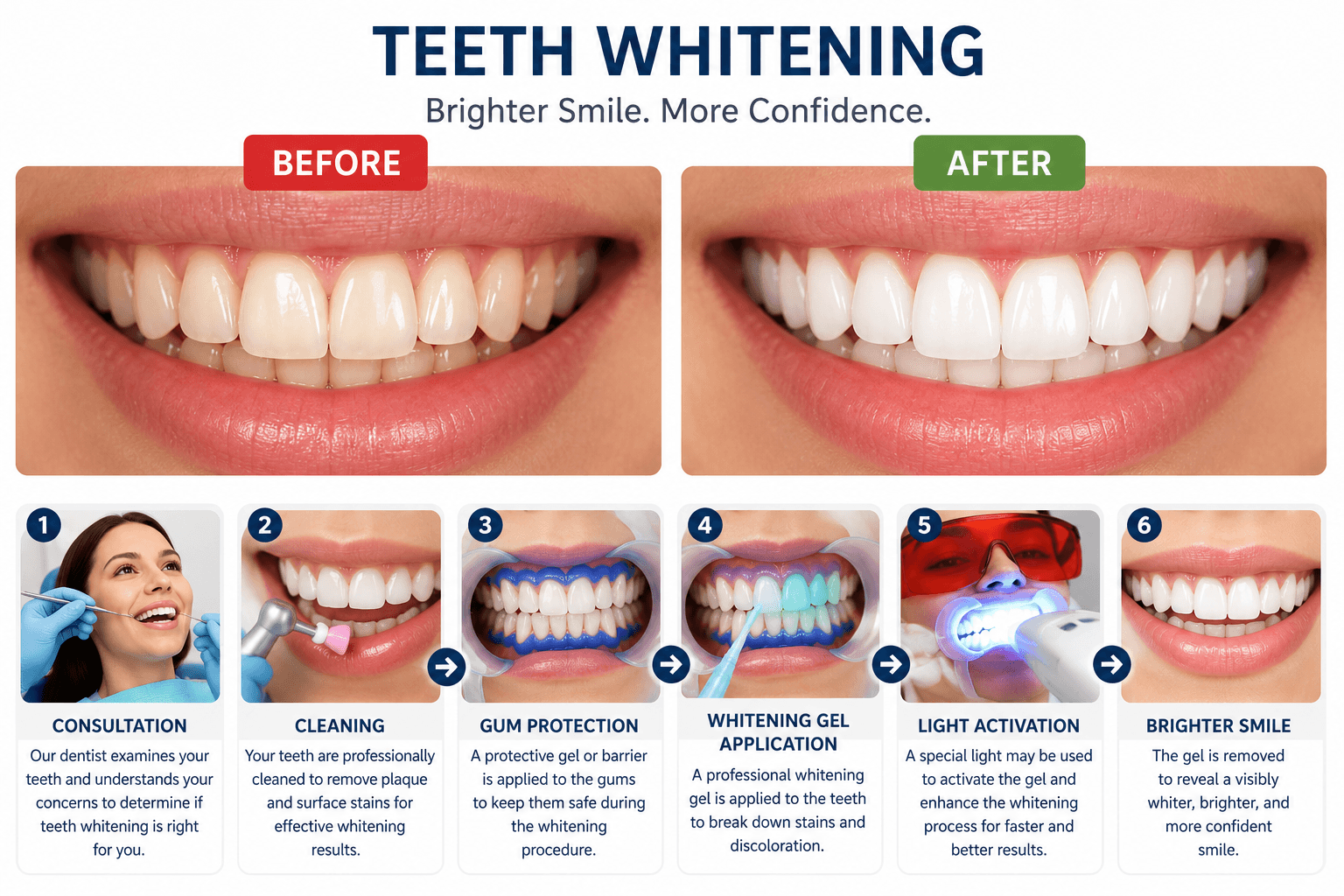 Teeth whitening before and after comparison and step-by-step professional whitening procedure