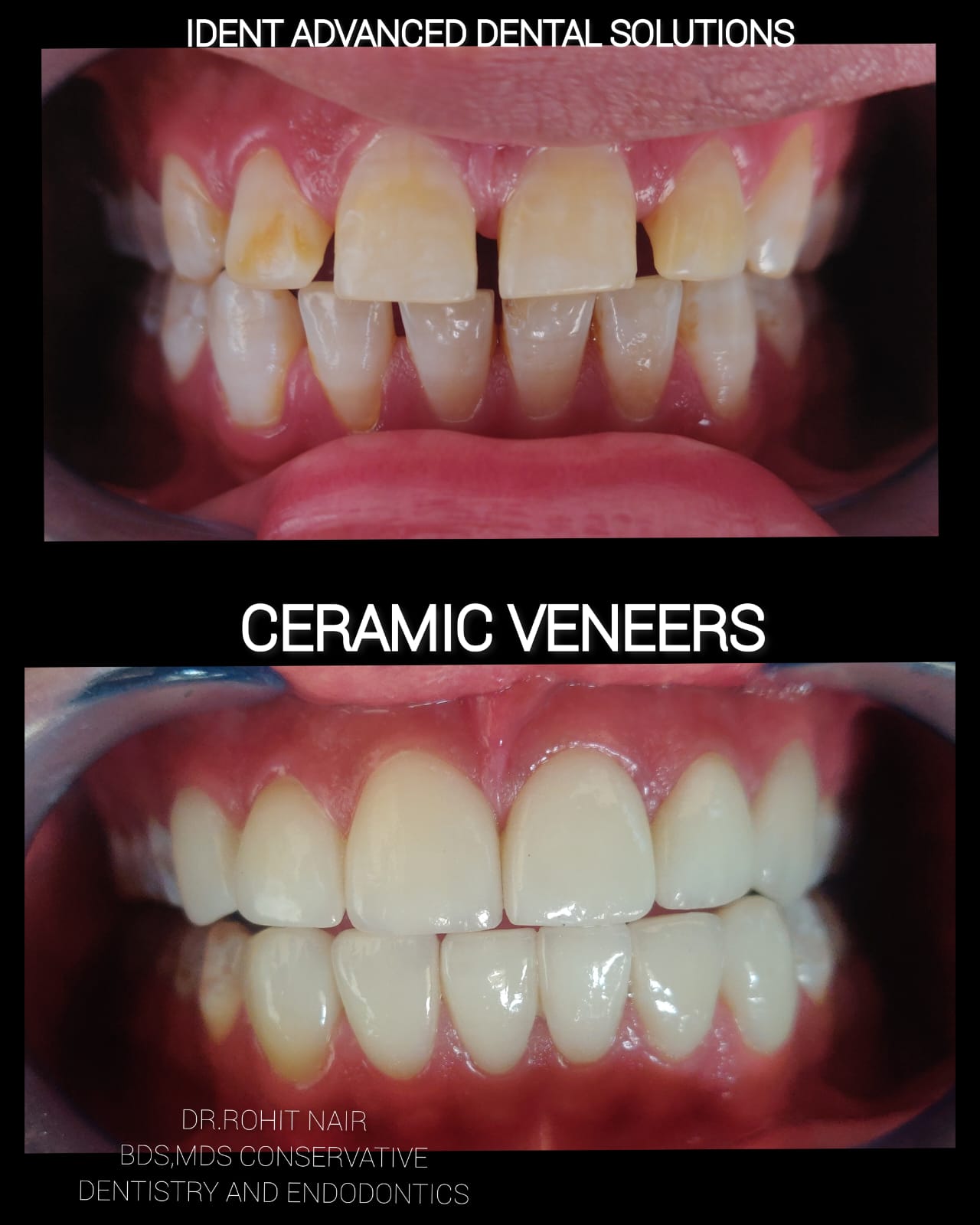 Ceramic veneers before and after at iDent